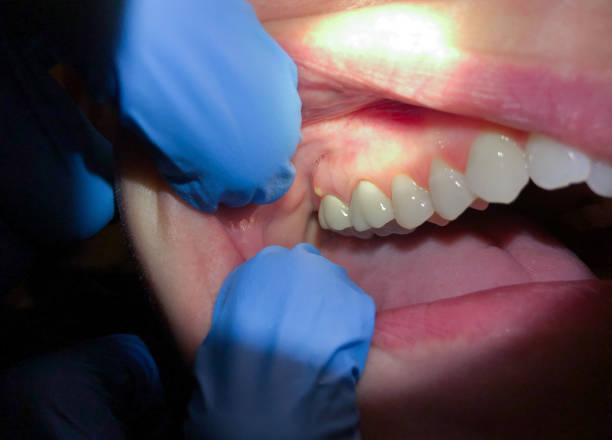 Best Emergency Dental Care for Broken or Chipped Teeth in North College Hill, OH